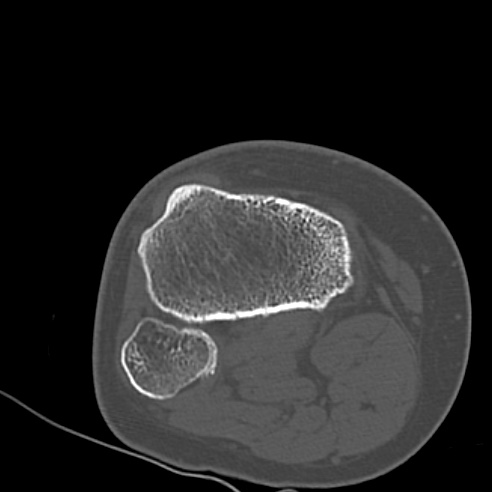 File:Anterior cruciate ligament avulsion fracture (Radiopaedia 58939-66194 Axial bone window 29).jpg