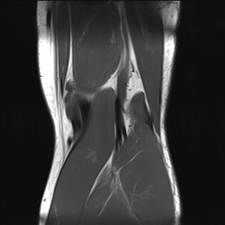 File:Anterior cruciate ligament full thickness tear (Radiopaedia 66268-75467 Coronal T1 18).jpg