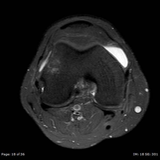 File:Anterior cruciate ligament tear (Radiopaedia 70783-80964 Axial PD fat sat 18).jpg