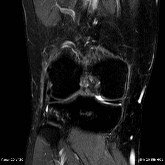 File:Anterior cruciate ligament tear (Radiopaedia 70783-80964 Coronal STIR 20).jpg