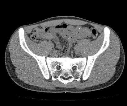 File:Anterior inferior iliac spine avulsion fracture (Radiopaedia 81312-94999 Axial non-contrast 31).jpg