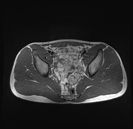 File:Anterior inferior iliac spine avulsion fracture (Radiopaedia 81312-95000 Axial T1 25).jpg