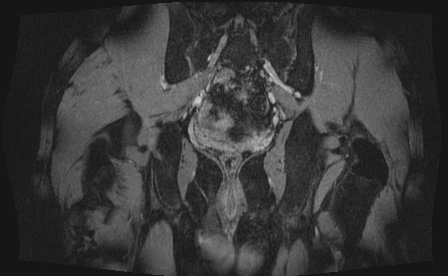 Anterior inferior iliac spine avulsion fracture (Radiopaedia 81312-95000 G 2).jpg
