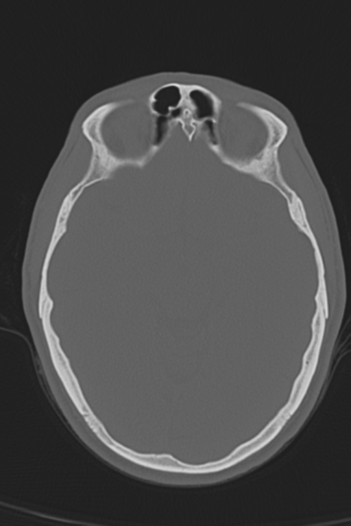 Anterior nasal spine fracture (Radiopaedia 46138-50494 Axial bone window 34).png
