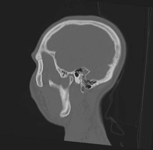 Anterior nasal spine fracture (Radiopaedia 46138-50494 Sagittal bone window 45).png