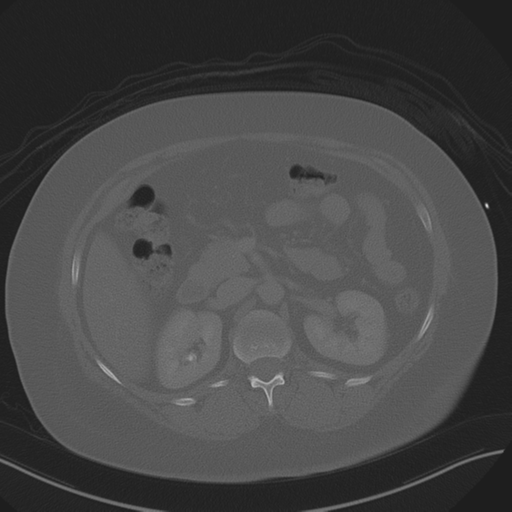 Anterior superior iliac spine avulsion fracture (Radiopaedia 44541-48244 Axial bone window 36).png