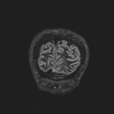 Anterior temporal encephalocele (Radiopaedia 82624-96808 Coronal FLAIR 51).jpg