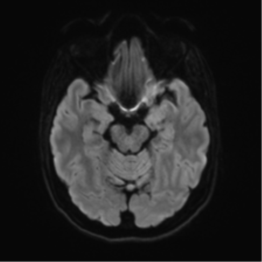 Anterior temporal lobe perivascular space (Radiopaedia 40946-43650 Axial DWI 37).png