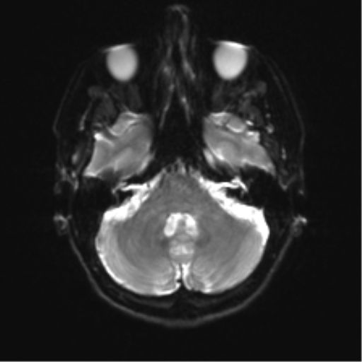 Anterior temporal lobe perivascular space (Radiopaedia 40946-43650 Axial DWI 6).png