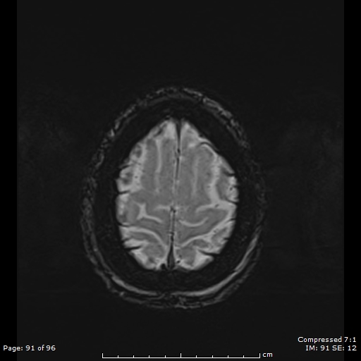 Anterior temporal lobe perivascular space (Radiopaedia 88283-104914 Axial SWI 60).jpg