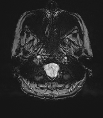 Anterior temporal pole cysts (Radiopaedia 46629-51102 Axial SWI 10).png