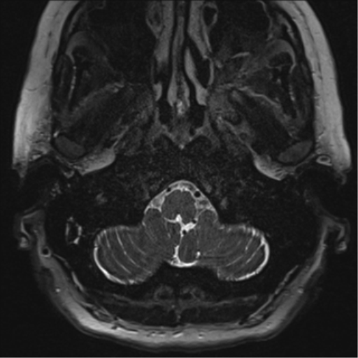 Anterior temporal pole cysts (Radiopaedia 46629-51102 Axial T2 4).png