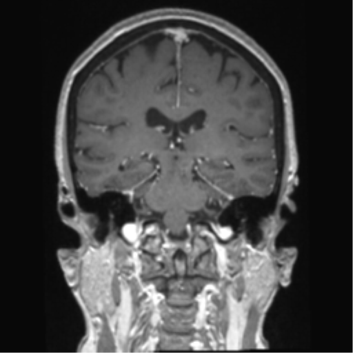 Anterior temporal pole cysts (Radiopaedia 46629-51102 Coronal T1 C+ 74).png
