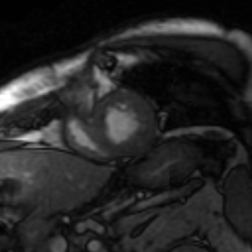 File:Anteroseptal hypokinesia after myocardial infarction (Radiopaedia 15978-15633 Short axis SSFE 12).jpg