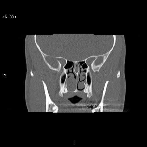 File:Antrochoanal Polyp (Radiopaedia 70510-80631 Coronal bone window 27).jpg