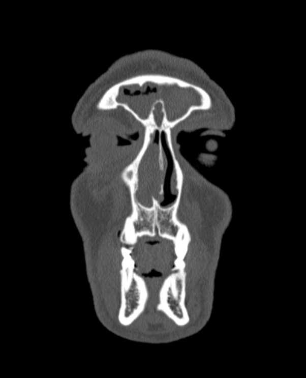 Antrochoanal polyp (Radiopaedia 79011-92169 Coronal bone window 77).jpg