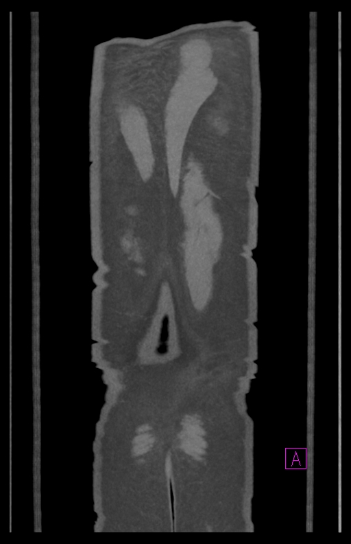Aortectomy and axillary-bifemoral bypass (Radiopaedia 28303-28545 C 91).jpg