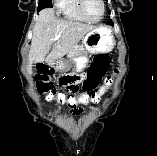 Aortic aneurysm and Lemmel syndrome (Radiopaedia 86499-102554 C 12).jpg