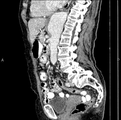 Aortic aneurysm and Lemmel syndrome (Radiopaedia 86499-102554 D 50).jpg