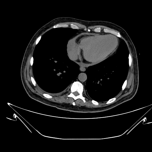 Aortic arch aneurysm (Radiopaedia 84109-99365 Axial non-contrast 200).jpg