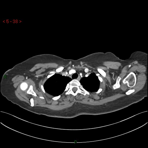 Aortic arch origin of left vertebral artery (Radiopaedia 51520-57286 A 37).jpg