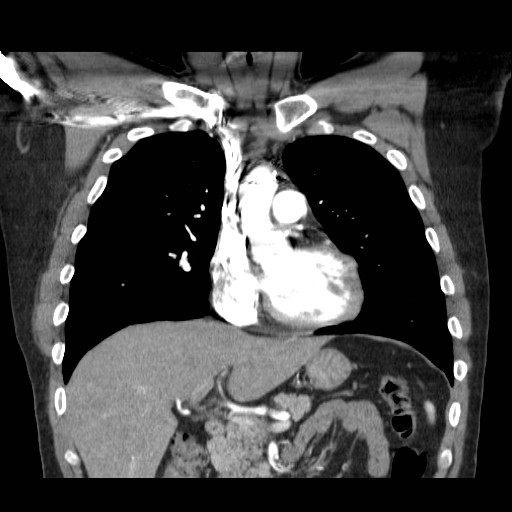 File:Aortic arch stent (Radiopaedia 30030-30595 F 7).jpg