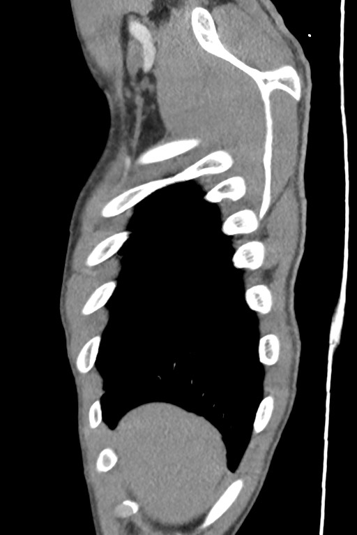 Aortic coarctation with aneurysm (Radiopaedia 74818-85828 B 23).jpg