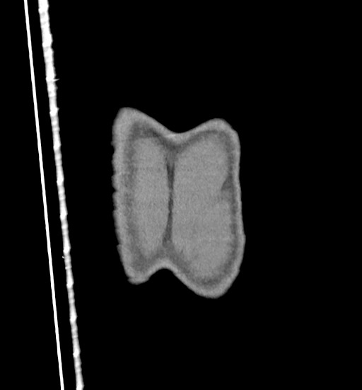 File:Aortic coarctation with aneurysm (Radiopaedia 74818-85828 C 121).jpg