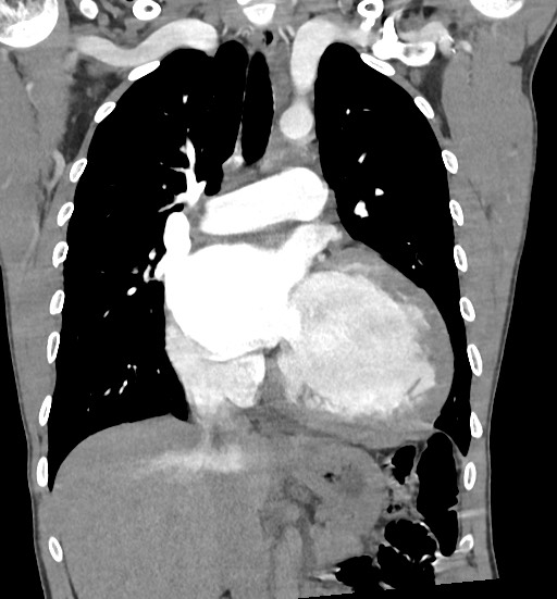 Aortic coarctation with aneurysm (Radiopaedia 74818-85828 C 55).jpg