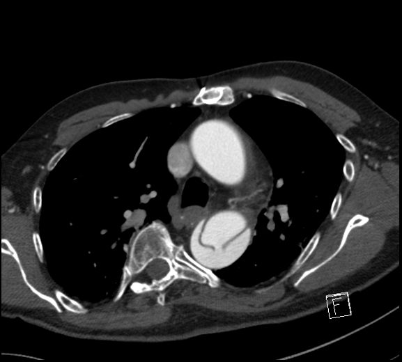 File:Aortic dissection (CTPA) (Radiopaedia 75506-86750 A 34).jpg