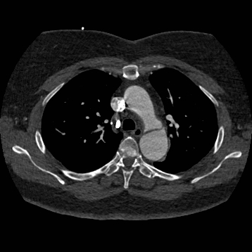File:Aortic dissection (Radiopaedia 57969-64959 A 112).jpg