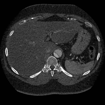 File:Aortic dissection (Radiopaedia 57969-64959 A 298).jpg