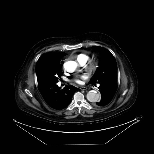 Aortic dissection (Radiopaedia 62562-71000 A 21).jpg