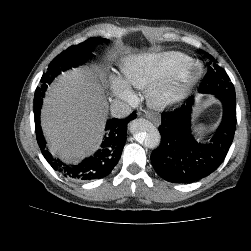File:Aortic dissection - Stanford A -DeBakey I (Radiopaedia 28339-28587 B 81).jpg