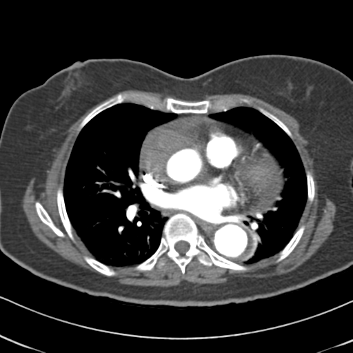 File:Aortic dissection - Stanford type A (Radiopaedia 39073-41259 A 42).png
