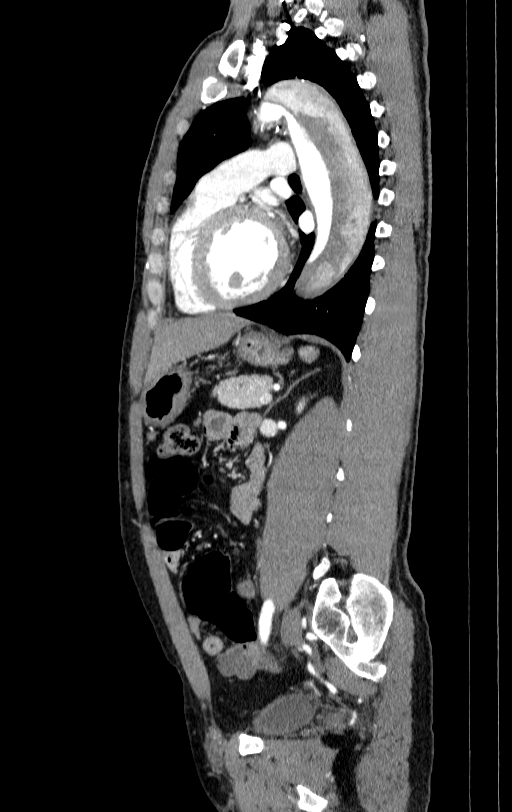 Aortic dissection - Stanford type A (Radiopaedia 83418-98500 B 56).jpg