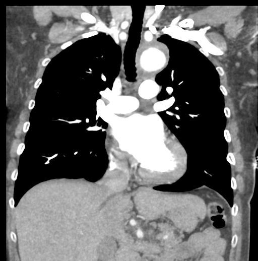 File:Aortic dissection - Stanford type B (Radiopaedia 50171-55512 B 40).png