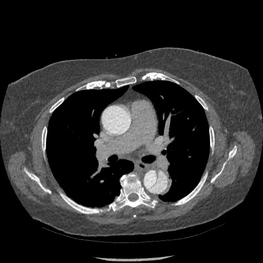Aortic dissection - Stanford type B (Radiopaedia 88281-104910 A 36).jpg