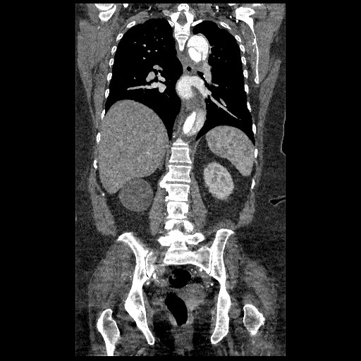 File:Aortic dissection - Stanford type B (Radiopaedia 88281-104910 B 55).jpg