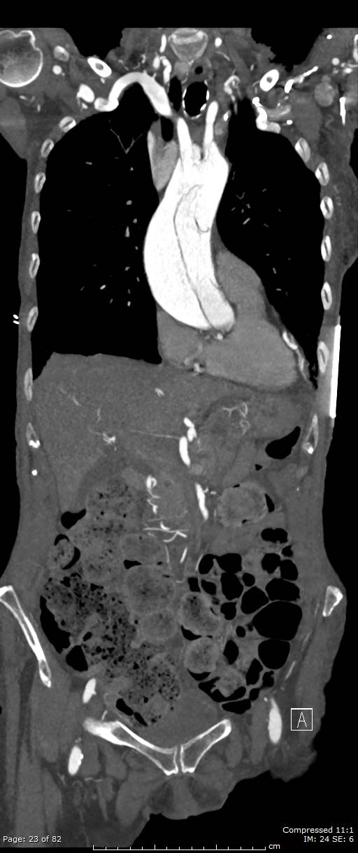 Aortic dissection with extension into aortic arch branches (Radiopaedia 64402-73204 A 23).jpg