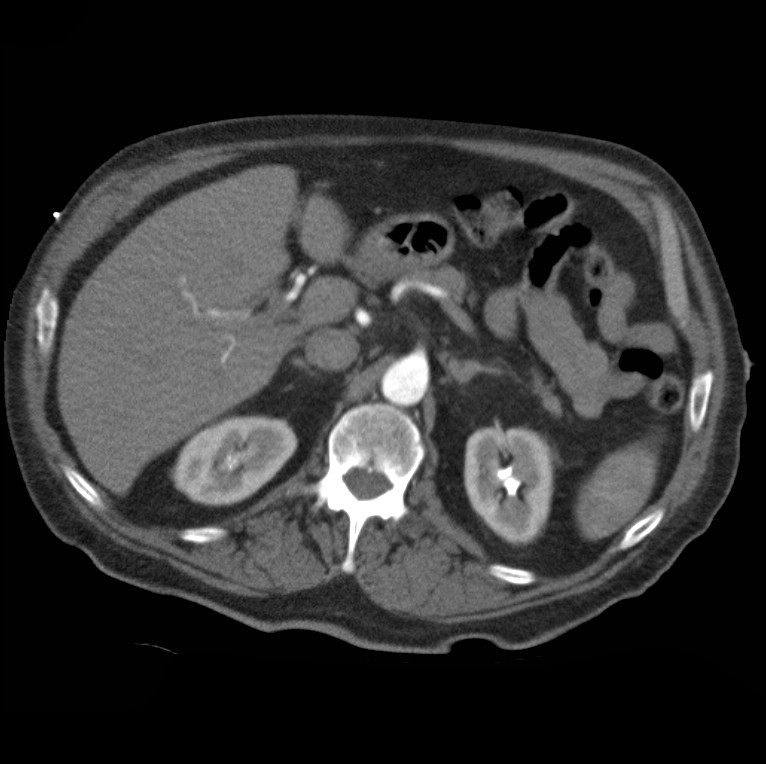 Aortic dissection with rupture into pericardium (Radiopaedia 12384-12647 A 57).jpg
