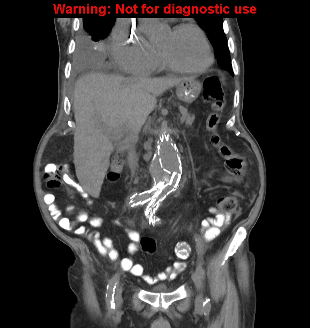 Aortic graft infection (Radiopaedia 44979-48907 non-contrast 21).jpg