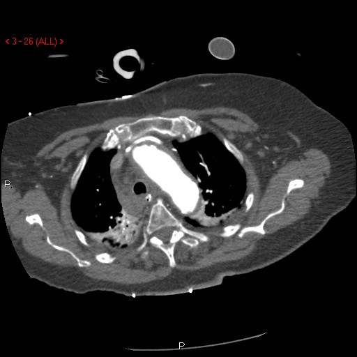 Aortic intramural hematoma (Radiopaedia 27746-28001 A 26).jpg