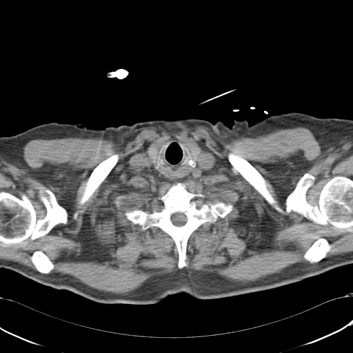 Aortic intramural hematoma (Radiopaedia 34260-35540 Axial non-contrast 3).png