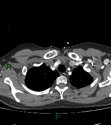 Aortic valve endocarditis (Radiopaedia 87209-103485 C 14).jpg