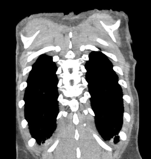 Aortic valve non-coronary cusp thrombus (Radiopaedia 55661-62189 C 70).png