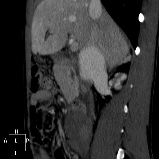 Aorto-left renal vein fistula (Radiopaedia 45534-49628 C 13).jpg