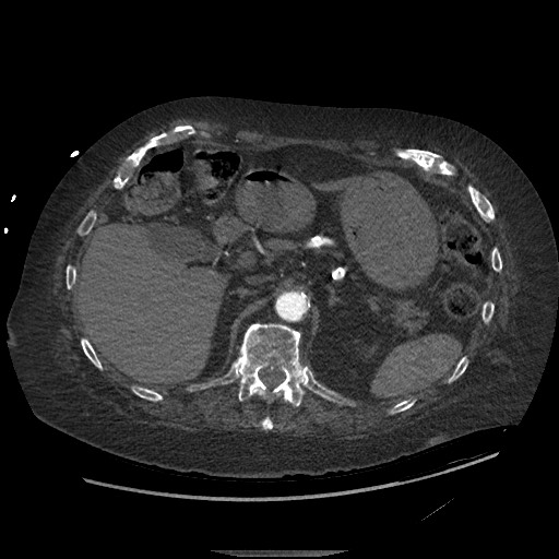 Aortoesophageal fistula with endovascular repair (Radiopaedia 73781-84592 Axial C+ CTPA 184).jpg