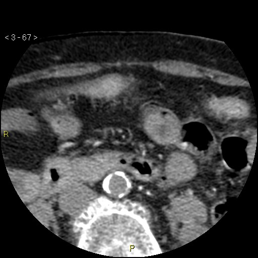 Aortoiliac occlusive disease (Radiopaedia 16828-16548 A 67).jpg