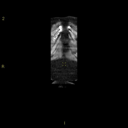 File:Aortoiliac occlusive disease (Radiopaedia 16828-16548 B 6).jpg